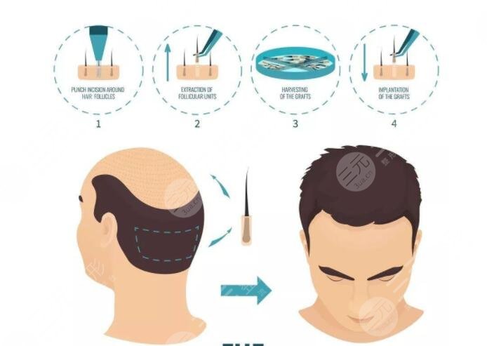 广东省人民医院植发项目科普