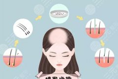5000个毛囊植发的价格受这5点因素影响,附注意事项 5000个毛囊植发的价格受这5点因素影响,附注意事项