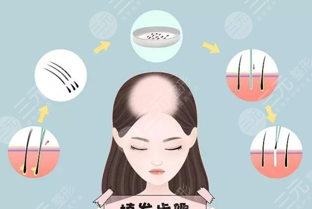 5000个毛囊植发的价格