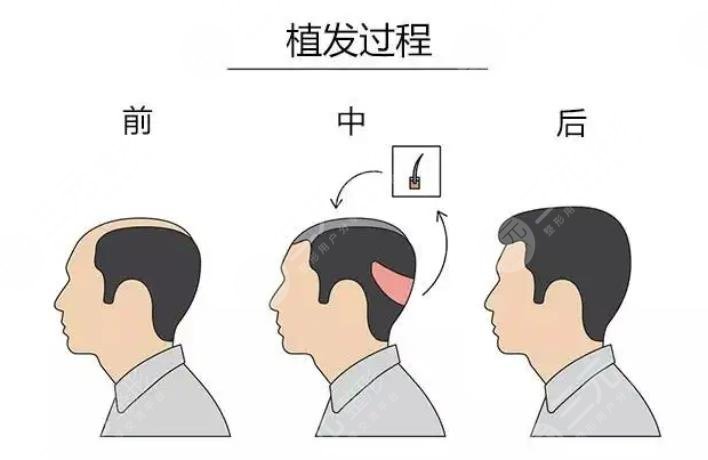 5000个毛囊植发的价格