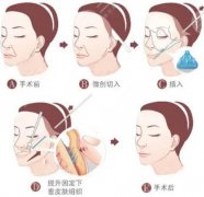 大拉皮手术15天照片前后对比照分享,确实年轻了不少 大拉皮手术15天照片前后对比照分享,确实年轻了不少