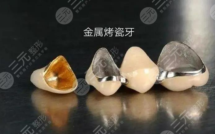 烤瓷牙多少钱一颗价格表2021-2022