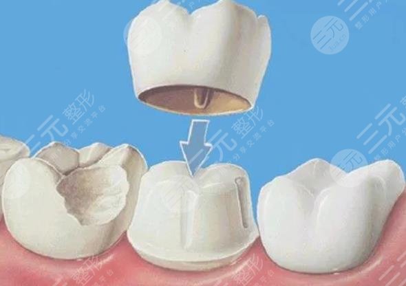 烤瓷牙多少钱一颗价格表2021-2022