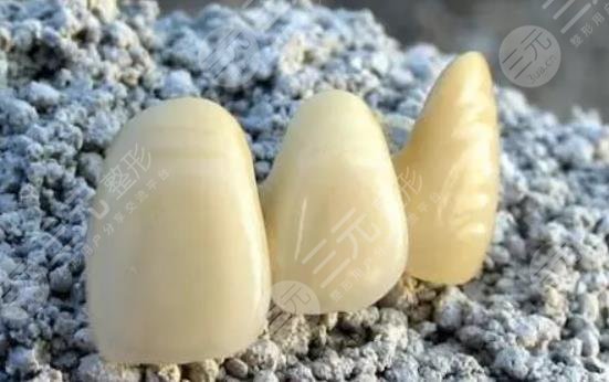 烤瓷牙多少钱一颗价格表2021-2022