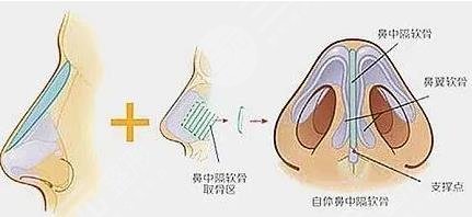 鼻中隔隆鼻