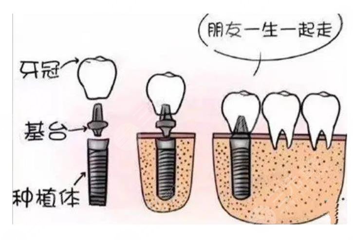 种植牙多少钱一颗?价格表+五大危害盘点!牙龈炎、感染...