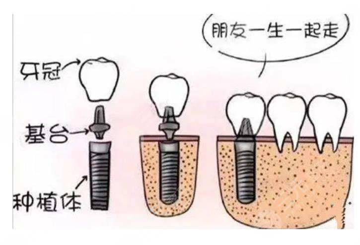 台湾安联种植牙