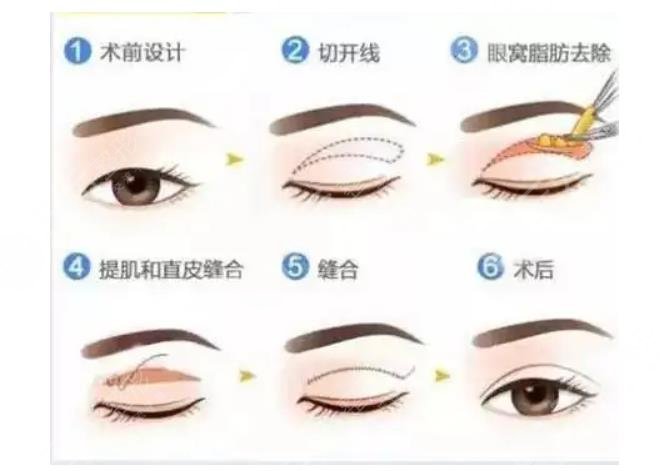 双眼皮手术常见手法 1、埋线法