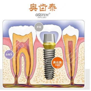 韩国奥齿泰种植牙多少钱一颗?
