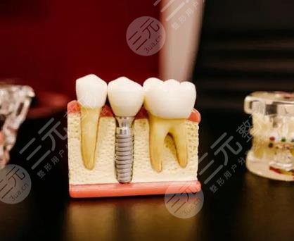 种植牙