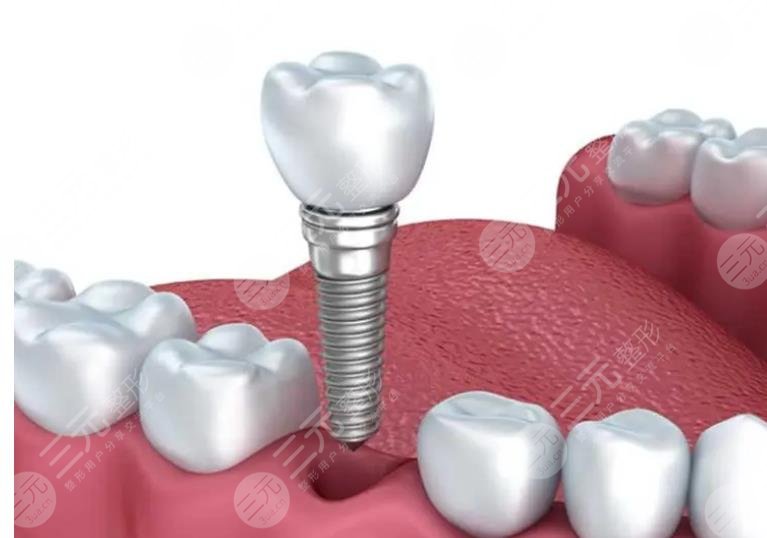 种植牙齿多少钱一个?收费价目表更新！附影响价格因素盘点！