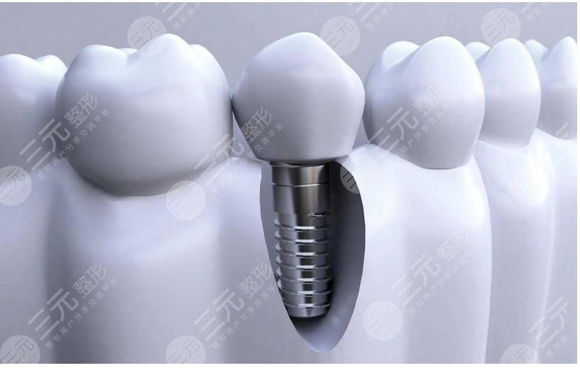 种植牙齿多少钱一个?收费价目表更新！附影响价格因素盘点！