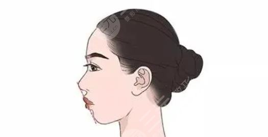凸嘴矫正