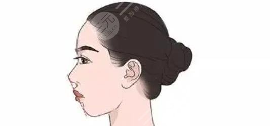 凸嘴矫正