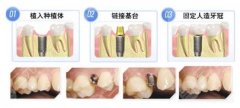济南种牙费用是多少?盘点5点价格影响因素! 济南种牙费用是多少?盘点5点价格影响因素!