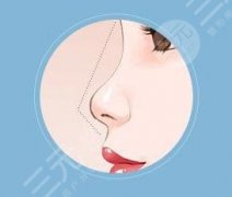 超体隆鼻和肋骨鼻哪个好，哪个价格贵？科普两种材料的3大区别！