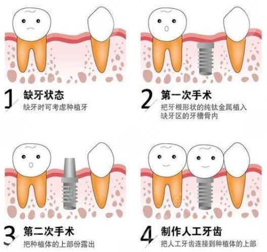 种植牙的五大危害