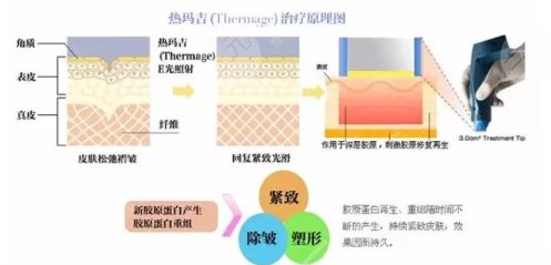 上海做热玛吉多少钱?价格影响因素有哪些?