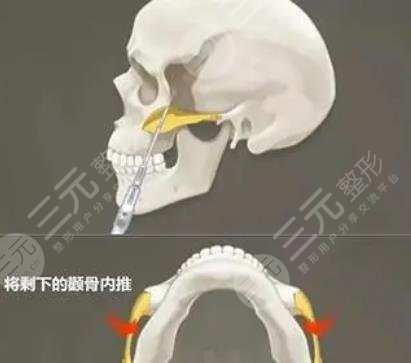 颧骨磨骨