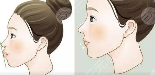 凸嘴矫正、