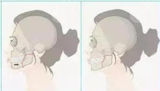 正颌矫正