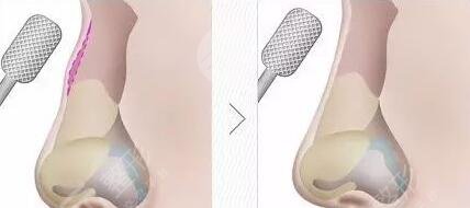 厦门海峡医疗张宏做鼻子价格