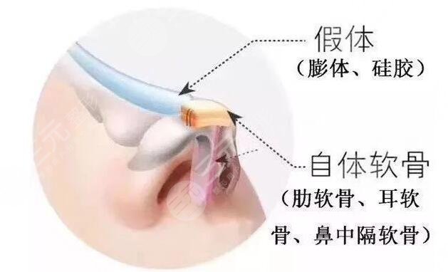 厦门海峡医疗张宏做鼻子好处