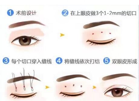 埋线双眼皮一到7天图片详细记录