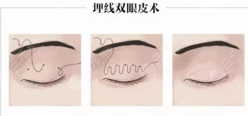 对照双眼皮失败的八种图片,看看自己是否手术失败了~