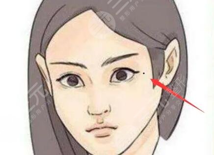 祛痣后10天恢复图片