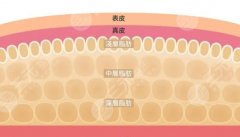 脂肪体雕的作用与好处科普！脂肪大挪移，塑形美体新选择~