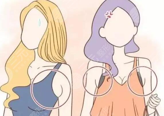 切除副乳对比图片：切除副乳手术术前
