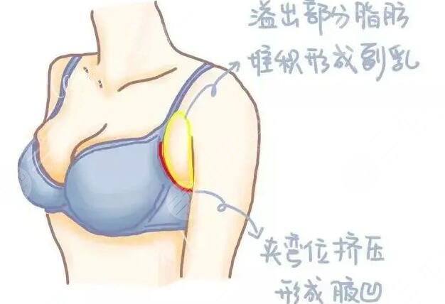 切除副乳手术后一天