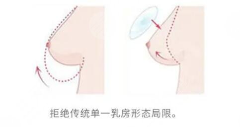 乳房悬吊提升手术的原理是什么?