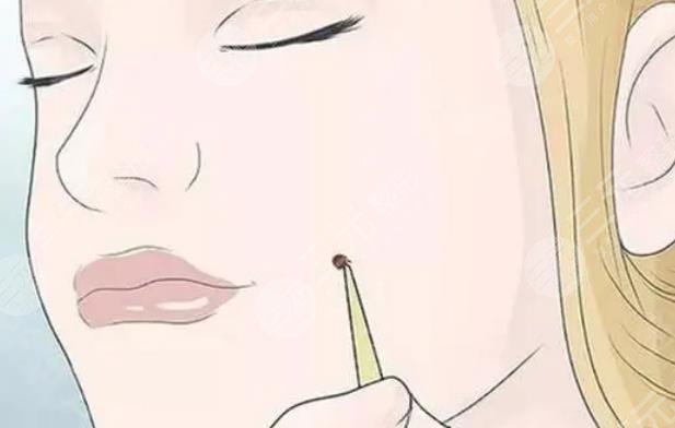 点完痣恢复过程图片分享，没有留下一点坑，真的好神奇！