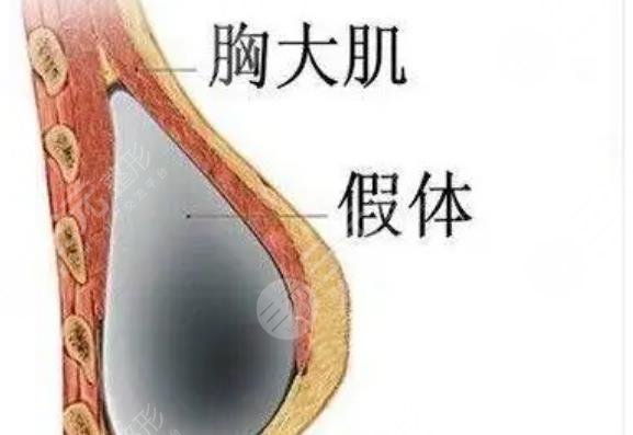 隆胸