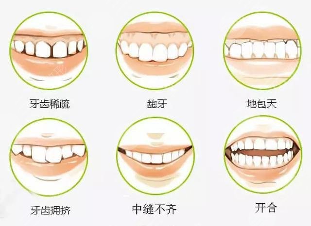 新会第二人民医院口腔科成功牙齿矫正案例