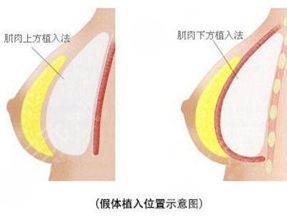 麦格假体价格多少？