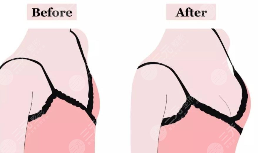 美国麦格假体优点和缺点