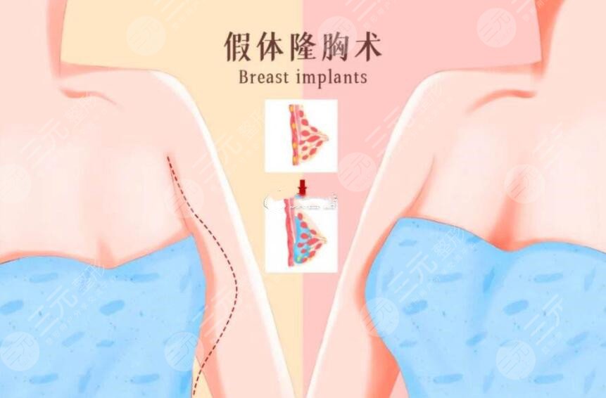 真人体验麦格假体隆胸果