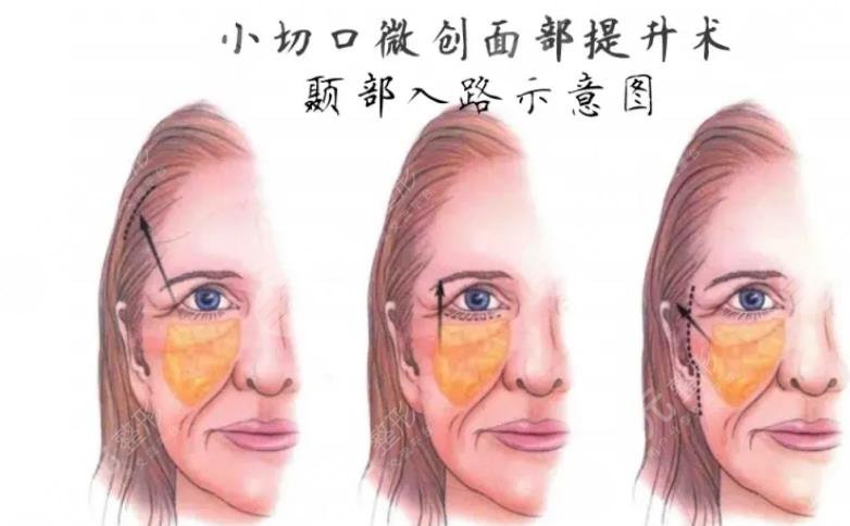 小切口拉皮手术恢复图过程图分享，紧致肌肤肉眼可见！