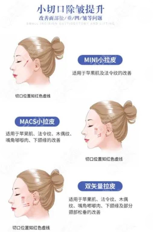 小切口拉皮手术恢复图术后30天