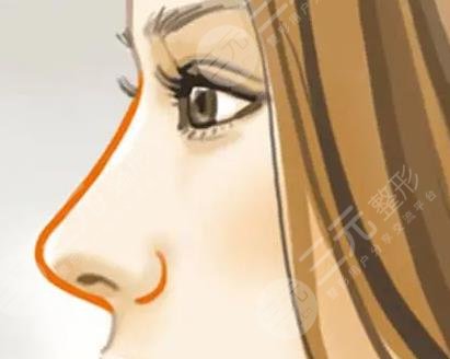 肋骨隆鼻1-7天恢复过程图分享！真人隆鼻体验经历分享+附收费价格表