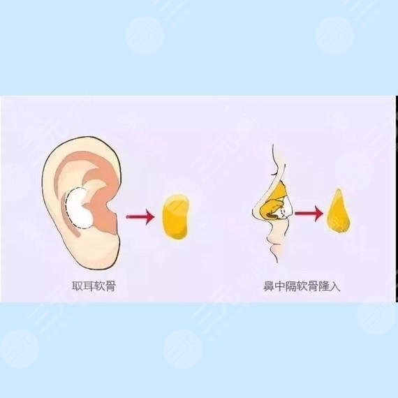 耳软骨和肋骨鼻子的区别在哪里?