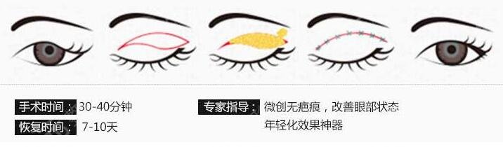 割双眼皮