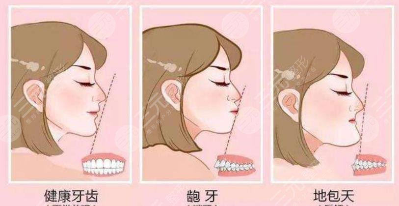 牙齿矫正科普