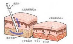 体雕溶脂果怎么样？原理|费用|注意事项3大手术问题科普，纤体指南！
