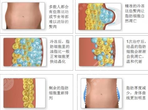 体雕溶脂