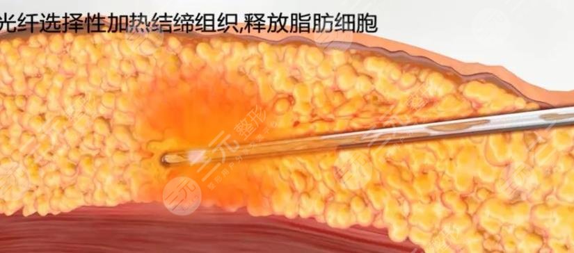 体雕溶脂