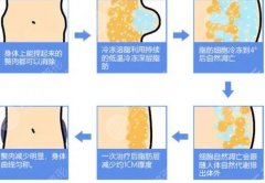 体雕和抽脂哪个果好？区别科普及对比，塑形美体必备攻略！